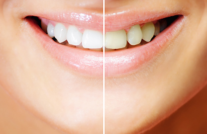 ホワイトニング